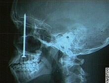 X-Ray of Nail in Skull